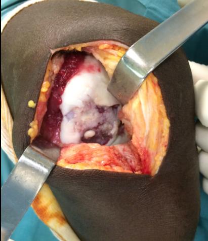 Figure 4: Arthrotomy and exposure of the osteochondral lesion in medial femoral condyle.
