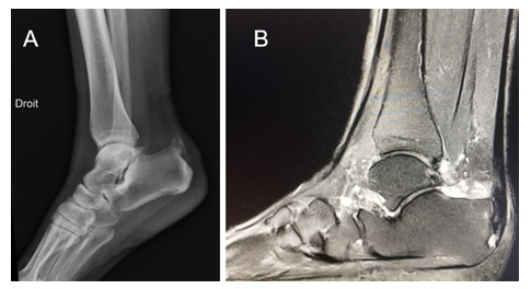 Figure 1: Lateral radiograph showing an opacity in the posterosuperior aspect of the calcaneal tuberosity (A), and right ankle sagittal DP Fat Sat MRI demonstrating hyperintensity within the tendon at its insertion site (B), suggestive of insertional Achilles tendinopathy.