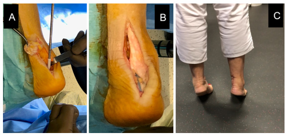 Figure 3: Passage of the graft through the blind tunnel and fixation with an interference screw (A), Achilles tendon reinsertion on anchors using a double-row suture technique (B), and restored plantar flexion at 6-month follow-up (C).