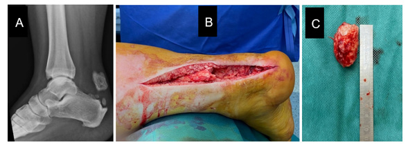 Figure 4: Lateral radiograph of the right ankle showing features of chronic insertional Achilles tendinopathy with distal tendon calcification (A), and appearance of tendon substance loss (B) after calcification resection (C).