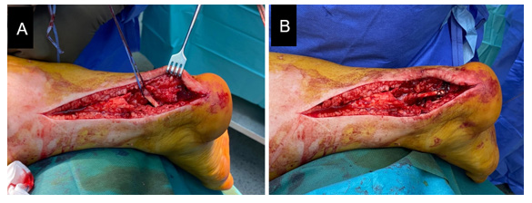 Figure 5: Tendon transection with the foot in equinus (A) and reinsertion using an interference screw (B).