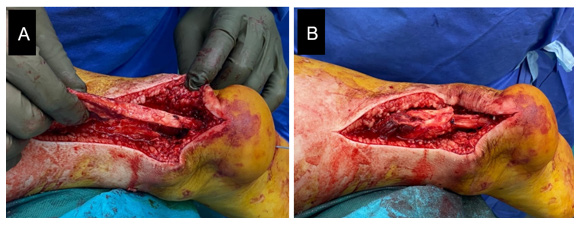 Figure 6: Quadriceps tendon graft harvested to fill the substance loss of the distal Achilles tendon (A) and final appearance after FHL augmentation and defect filling (B).