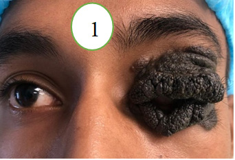 Figure 1: The diffuse, giant, melanocytic, pigmented naevus involving the upper and lower eyelids, including the eyelid margin.