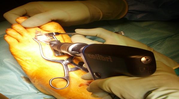 Figure 1: Dorsal closing wedge osteotomy with power saw.