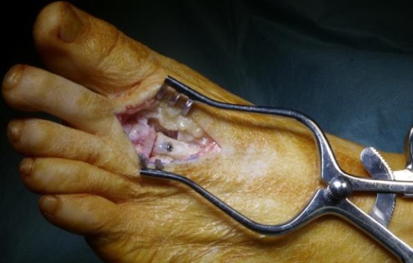 Figure 3: The joint cartilage is debrided.