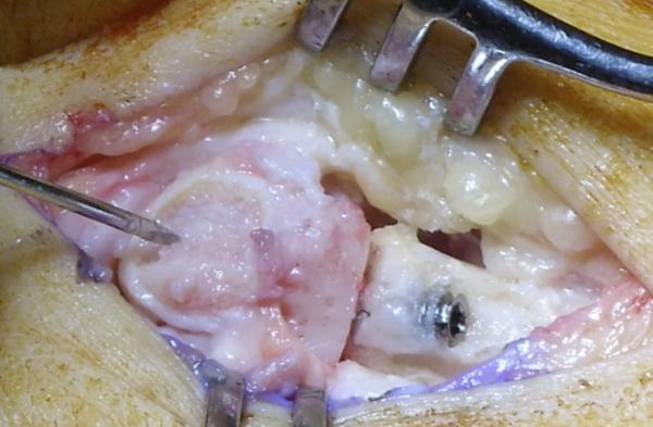 Figure 4: Micro-fracture with K wires.
