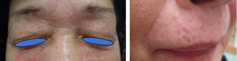 Figure 1: Clinical features of Case 1. Papular eruptions around eyes and perioral.