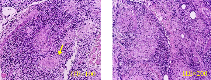 Figure 5: Pathological findings of Case 3. Clumped epithelioid cells and densely infiltrated lymphocytes Degenerated nerve bundle is shown (arrow).