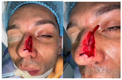 Figure 1: Nasal defect. Note the involvement of 50% of the anatomical subunit.
