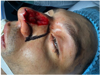 Figure 2: Flap design. The lateral limit extends beyond the nasal lateral wall and the inferior limit respects the left nasal ala.
