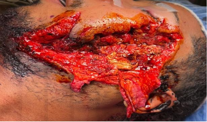 Figure 1: Gunshot wound with exposed parotid gland.