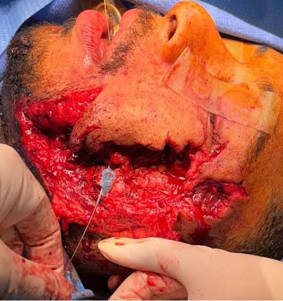 Figure 2: Angiocatheter used as an intraductal stent during parotid duct anastomosis.