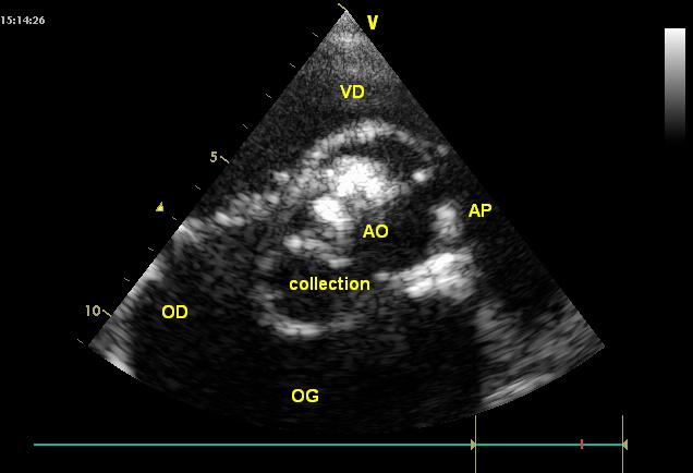 Figure 3: Posterior aortic ring abscess during mixed shock (septic and cardiogenic).