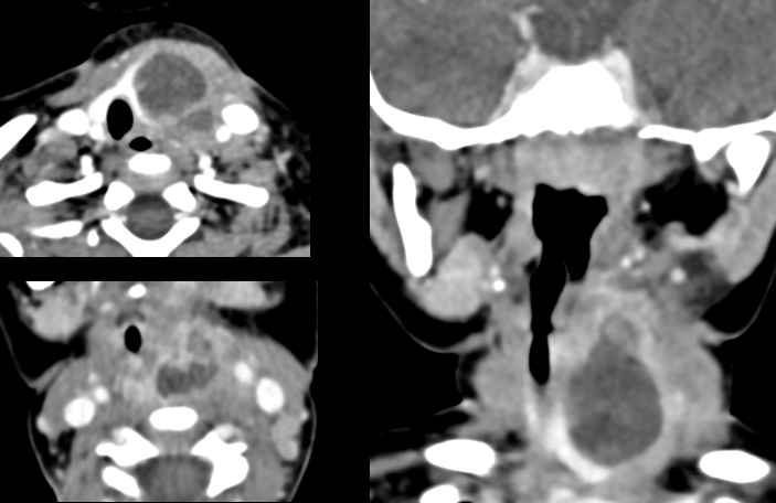 Figure 1: CECT Neck suggestive of enhancing collection in left lobe of thyroid, with lesion extending to parapharyngeal space up to the pyriform fossa.