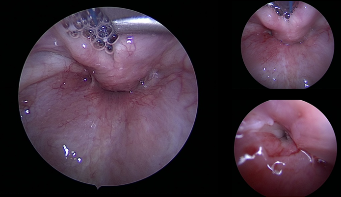 Figure 3: DIRECT LARYNGOSCOPY: Opening seen in left pyriform fossa (Endoscopic picture post electrocauterization of the opening).