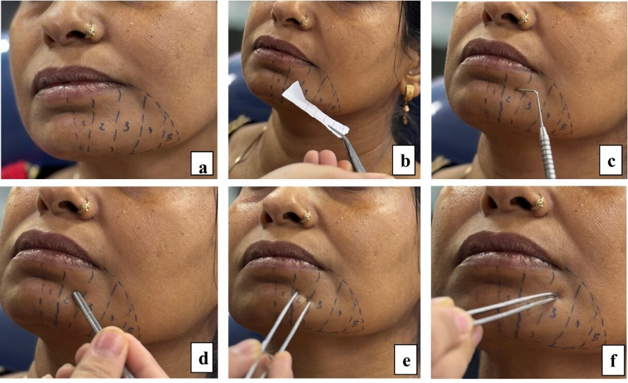 Figure 1: Neurosensory evaluation tests performed. a. Mapping of the injury site; b. Light touch perception; c. Sharp discrimination test ; d. Blunt discrimination test; e. Two point discrimination test (open beak); f. Two point discrimination test (close beak) **Mapping the injury area:** The involved neuropathic region was carefully mapped and recorded by marking its extent on the patient’s face with a ballpoint pen.