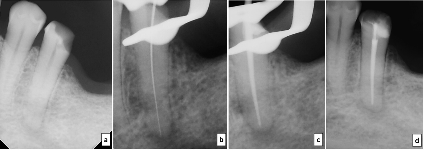 Figure 3: Endodontic management of mandibular left second premolar (#20). a. Pre-operative Radiograph b. Working length determination c. Master cone d. Obturation and post endodontic restoration **Clinical Procedures:** Non-surgical endodontic treatment was advised in respect to #20. During the first visit, local anesthesia was achieved with 2% lidocaine containing epinephrine 1:100,000 (Xicaine, ICPA, INDIA) and tooth was isolated under rubber dam, caries was excavated and access cavity was prepared. Patency was achieved with a stainless steel #10 K file (Mani, Inc. MDCI Ltd. Japan). The working length was determined using electronic apex locator (Root ZX®  II, Densply, J-Morita Inc., USA), and confirmed radiographically thereafter. Biomechanical preparation was done with  Neo-endo files (Orikam Healthcare, India) up to 35.04% till working length. Between instrumentation, the root canals were irrigated with 2 mL of 2.5% sodium hypochlorite solution (Bharat Chemical, India), using 30G side vented needle (Endo-Rinse, SuperEndo, India), kept 2mm short of the apex. Calcium Hydroxide (Ca[OH]2) (Prevest DenPro, India) paste was then placed in the root canal and the access cavity was sealed with temporary filling material. (Orafil-G™, PREVEST DenPro, India). The patient was prescribed a vitamin B-complex supplement as part of the supportive management. One week later, the patient reported the onset of pain sensation in the subcutaneous region of the lower lip and chin, corresponding to a neurosensory score of S1. The temporary restoration was removed, and the root canal system was irrigated with saline (0.9% v/w, Infutec, India). The intracanal medicament was refreshed using a combination of calcium hydroxide and chlorhexidine (Ammdent Dentochlor). At the subsequent visit, with improvement in the neurosensory function to S2 and absence of any tooth-related symptoms, obturation was performed using a bioceramic sealer (Bioactive RCS, Safe Endo, India) in conjunction with a single-cone gutta-percha technique. The access cavity was restored by placing a thin layer of resin-modified glass ionomer (Glasseal, Waldent, India) over the gutta-percha as an intra-orifice barrier to enhance coronal sealing, followed by acid etching, application of a dentin bonding agent, and placement of composite resin as the definitive restoration. (Te-Econom Plus, Ivoclar Vivadent India Pvt. Ltd.).