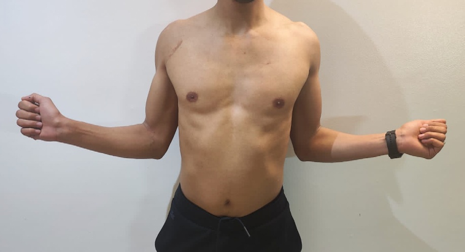 Figure 1: Clinical photograph showing a patient with a restoration of external rotation (ER1) on the right side at 5 months postoperatively. This patient, a mason by trade, successfully returned to full-capacity manual labor.