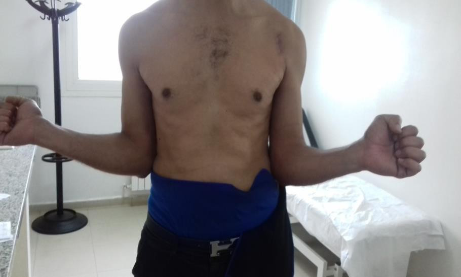 Figure 2: Clinical photograph illustrating limited external rotation recovery on the left side, this patient was unable to resume heavy manual labor and required professional retraining.