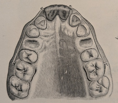 Figure 1: Appliance for retracting the anterior segments after upper first premolar extractions: Chupein 1894.