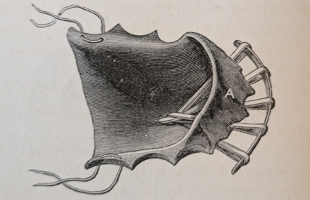 Figure 10: Upper inclined plane appliance for “jumping the bite.” Rodrigues Ottolengi [18] stated in 1907 that “Dr. Kingsley long ago announced the doctrine of “jumping the bite” but Dr. Angle has pointed out that in cases treated after the full complement of teeth has erupted while of course the bite may be jumped, the mandible will not always remain in forward pose. Clearly an age factor is involved and Ottolengui recommended “releasing the mandible from its imprisionment as early as possible”.