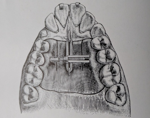 Figure 11: Upper expansion appliance with midline screw.