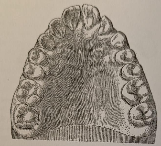 Figure 12: Models before and after treatment: Kingsley 1880.