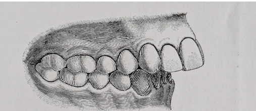 Figure 13: Models before treatment: Bogue 1887.