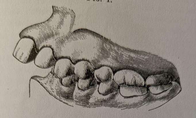 Figure 15: Occlusion before treatment: Bogue 1887.
