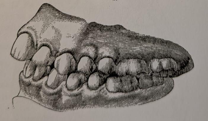 Figure 16: Occlusion after treatment: Bogue 1887.