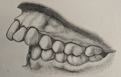 Figure 2: Lateral view models before treatment.