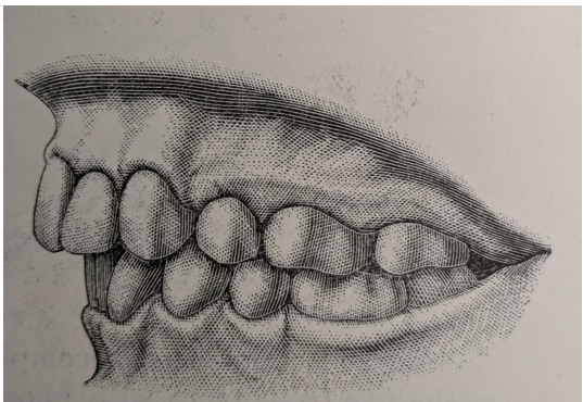 Figure 3: Lateral view models after treatment.