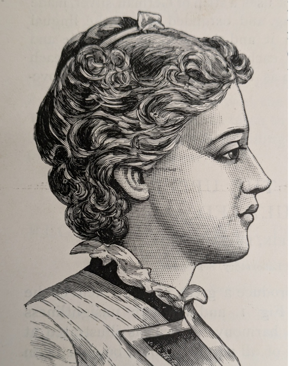 Figure 6: Early functional appliance result: Cutter 1894.