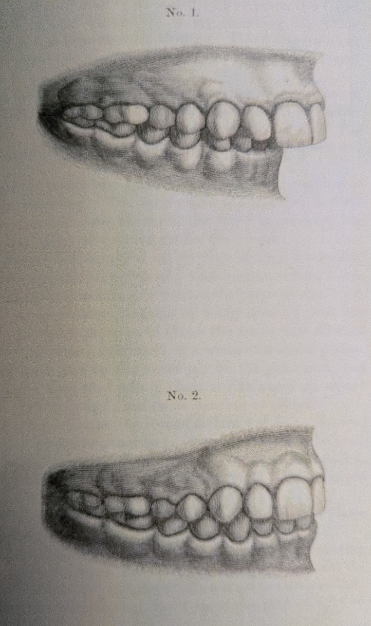 Figure 7: Early functional appliance result: Hamilton 1892.