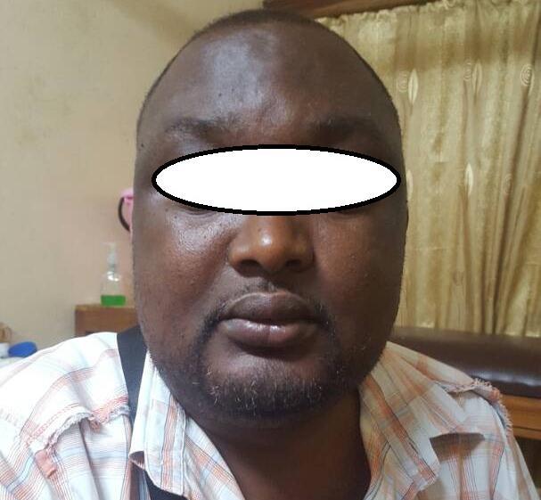 Figure 1: Facial image of the patient showing a moon face and puffed jaws.