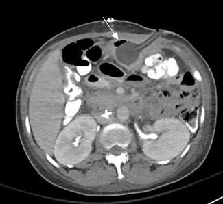 Figure 1: Axial abdominopelvic CT image (2/22/2017) shows a gastrostomy tube within the gastric lumen near its entry site.