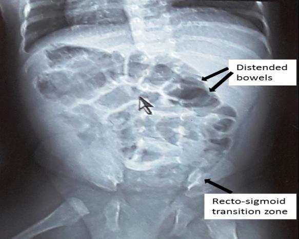 Figure 1: Plain abdominal radiograph showing a transitional zone at the rectosigmoid from YGOPH.
