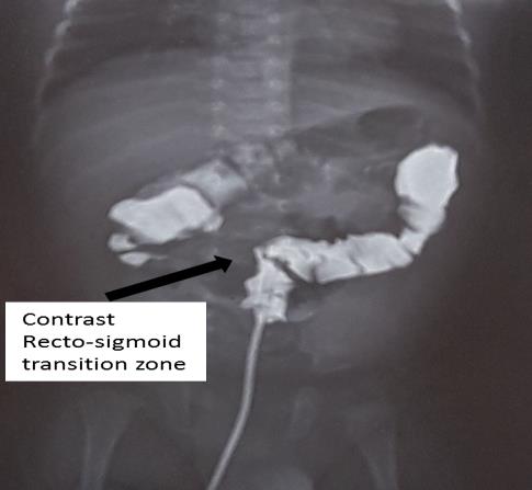 Figure 2: Contrast enema transition zone at the recto- sigmoid from YGOPH. Working diagnosis: Hirsch sprung disease. The management consisted of: pre-operatory hospitalisation, preoperatory bowel preparation, preoperative anesthetist consultation, senior paediatric surgeon’s reassessment, and peroperatory antibiotic prophilaxis. The surgical intervention (Figure 3) consisted of: transanal pull through during which with the patient lying on a paediatric surgical table in a lithotomy position with the limbs flexed and the anal orifice exposed, traction sutures are placed at the 4 cardinal points to allow eversion of the mucosa. In filtration of the submucosa 1cm above the pectineus line so as to ease dissection. 1cm of the anal mucosa is left in place. The rectum including its muscularis mucosa is pulled through the anal orifice and resected at the end of the sigmoidal dilatation followed by coloanal anastomosis by full thickness interrupted suture and finally removal of traction sutures.