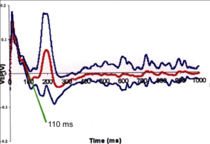 Figure 11: Flash VEP on Optic Nerve Compression Injury group. Latency time=110msec.