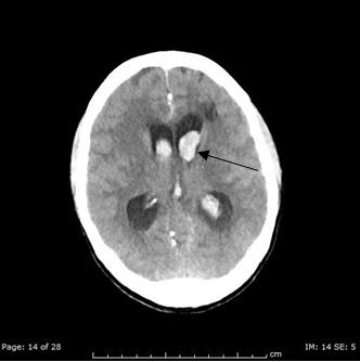 Figure 1: Axial noncontrast head CT image demonstrates acute intraventricular hemorrhage.