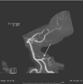 Figure 2: MR maximum intensity projection 3D image of the posterior circulation demonstrates a 4 mm right PICA aneurysm.