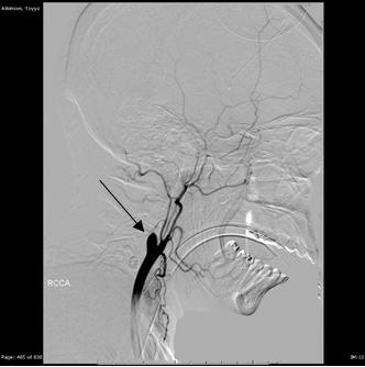 Figure 3: Right CCA injection conventional angiographic image demonstrates a tapered cutoff of the proximal right internal carotid artery.