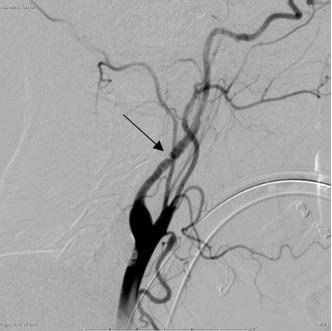 Figure 4: Left CCA injection conventional angiographic image demonstrates a beaded appearance of the cervical segment of the left internal carotid artery.