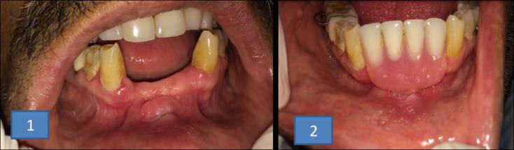 Figure 1: Sessile exophytic growth on the lower labial mucosa. Figure 2: Denture lying over the lesion. Epulis is a very generic term referring to gingival masses of mixed cell origins and are mostly resides of periodontal cells [1]. The term ‘epulis’ was given by Virchoff, which means ‘over the gums’. As the term refers only to site much preferred term is ‘denture-induced fibrous hyperplasia’.2 Other names used to describe the lesions are redundant tissue, denture injury tumor, and denture epulis.3 Denture-induced fibrous hyperplasia is an adaptive growth because of chronic irritation from badly adapted dental prosthesis [2]. Other causes include wearing denture day and night continuously, poor oral hygiene, smoking, age-related changes, and systemic conditions [3]. Females are usually affected, with age group of 30-60 years, with a peak incidence in the sixth decade. Maxilla is more affected than mandible. Anterior portion of jaws is often involved [4]. In our case, anterior portion of mandible of a male patient who was in his sixties was affected. Ill-fitting denture and poor oral hygiene induced oral mucosal overgrowth in our patient. Clinically, the growth may be single or numerous composed of flaps of hyper plastic tissue. And the presence of inflammation varies [4]. It is a raised sessile mass in the form of folds with a smooth surface and normal or erythematous overlying mucosa. Due to chronic irritation, it may get traumatised and present with ulceration on the surface. This mucogingival hyperplasia is a reactive condition of oral mucosa to excessive mechanical pressure on mucosa (as seen in our patient). It produces pain and discomfort but does affects the mastication, aesthetics and overall well-being of the individual. Chronic trauma inthe oral cavity may predispose the patient to carcinoma [2]. Lesions with almost similar clinical features are pyogenic granulomas, fibromas, peripheral giant cell granulomas, peripheral ossifying fibroma, neurofibroma, oral squamous cell carcinoma [4]. Diagnosis is made based on the history and clinical examination of the patient. After surgical excision histopathological examination is required to come to a confirmatory diagnosis. Treatment includes conservative or surgical management based on the duration and size of the lesion. It includes immediate withdrawal of the ill- fitting prosthesis followed by topical application of antifungal agents and paste containing anaesthetics with local analgesics. Fabrication of new denture should be carried out. In cases of fibrous growth, excision of the lesion becomes necessary. Excision is done either by conventional surgical method or by using laser (a carbon dioxide laser, Erbium: YAG laser, Neodymium-YAG laser, or diode laser) [2,4]. Everything said and done, surgical excision of the lesion remains the best treatment for epulis fissuratum, as carried out in the present case. Prognosis is always good. To conclude, epulis fissuratum is usually seen in elderly people with chronic trauma associated with ill fitting dentures. Hence care should be practised while fabricating dentures and frequent review must be performed to check for ridge resorption. Proper hygiene of the denture must be instructed.