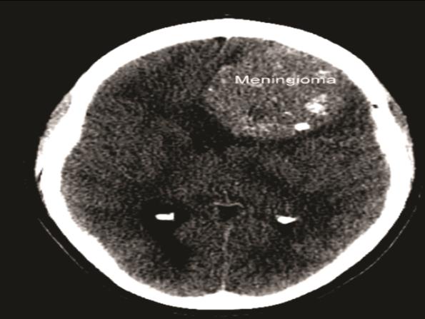 Figure 1: Computer tomography scan of head showing large left frontal meningioma with midline shift.
