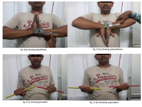 Figure 2: Clinical pictures of the same patient in Figure 1, showing excellent functional outcome.