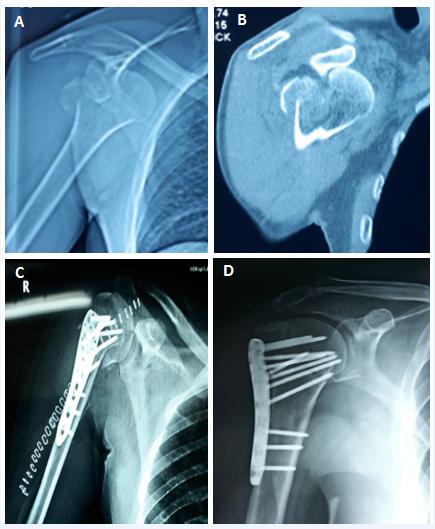Figure 1: A: Pre-operative plain shoulder radiograph showing anterior shoulder dislocation with greater tuberosity fracture with unseen humeral neck fracture. B: Pre-operative CT scan showed an associated un displaced humeral neck fracture. C: Plain shoulder radiograph taken 1 day post operatively showing the stable fixation construct. D: Plain shoulder radiograph taken 5 months post operatively showing the stable fixation construct, adequate bony union and absence of humeral head AVN.