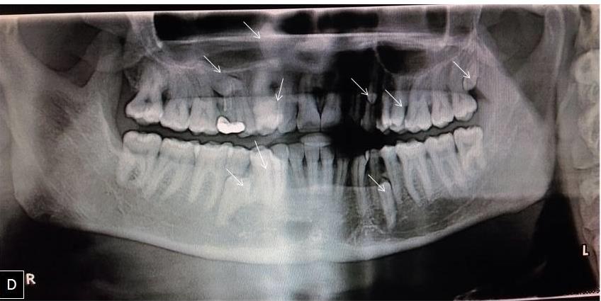 Figure 1: Extraoral facial profile.