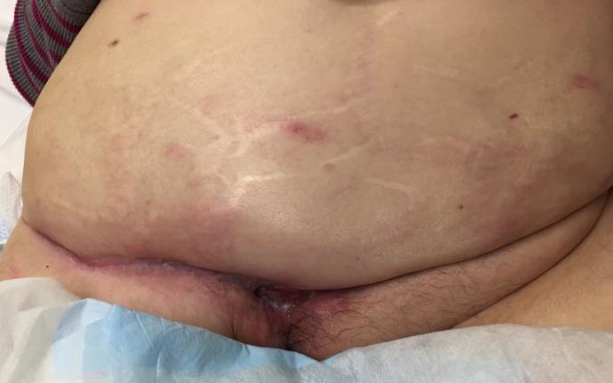 Figure 3: Operative repair of the bladder perforation noted during debridement.