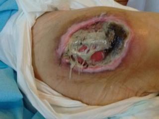 Figure 1: Patient with infected pressure ulcer selected in this study.